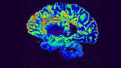 MRI of brain with brain lesions